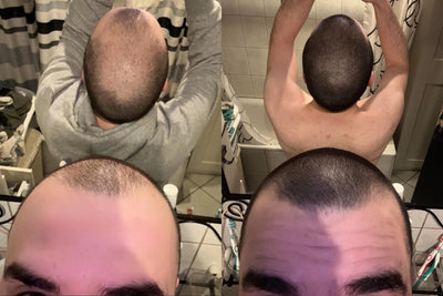 Alfavita™ Hair Regeneration System (2 months)