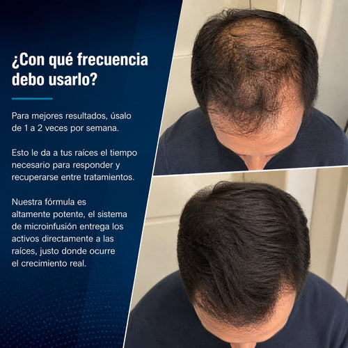 Alfavita™ Haarregenerationssystem