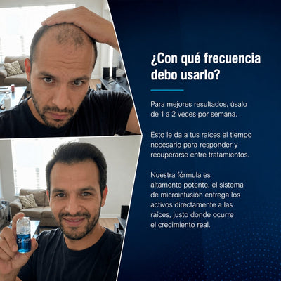 Alfavita™ Haarregenerationssystem (2 Monate)