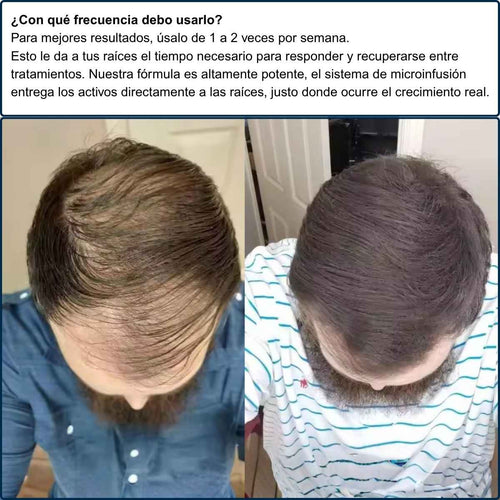 Alfavita™ Haarregenerationssystem